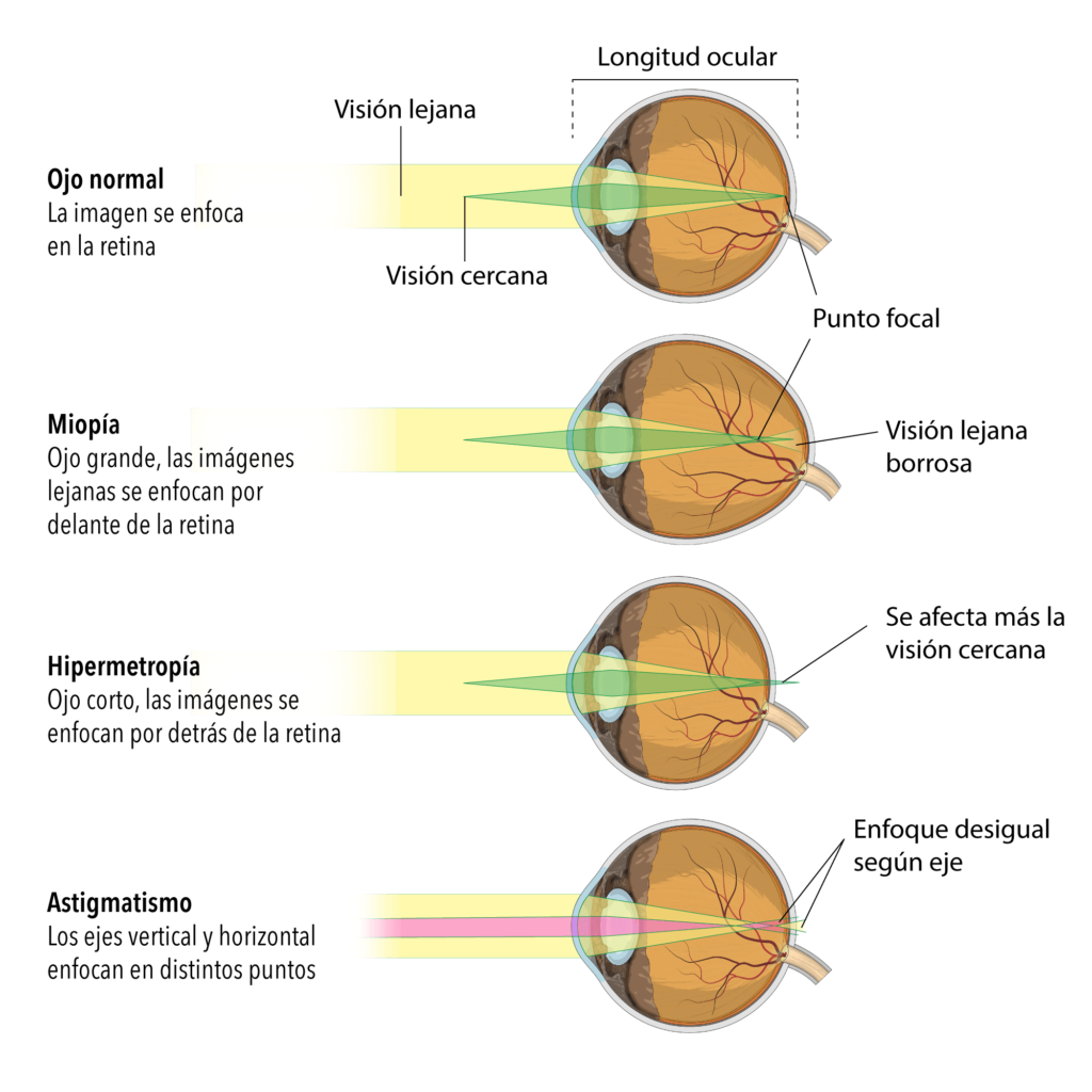 Refracción ocular