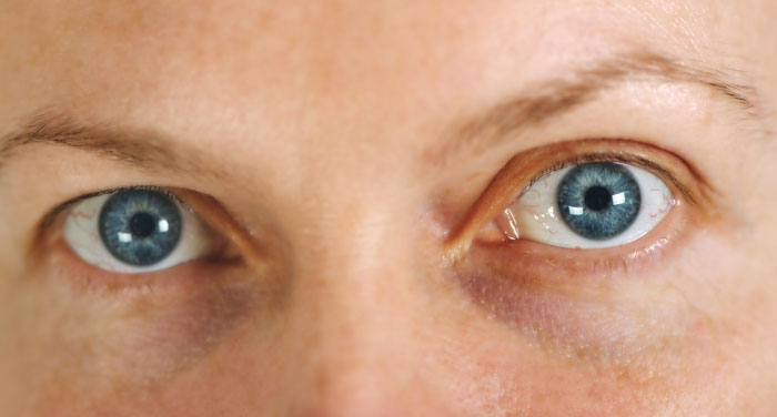 Qué es el glaucoma y cómo prevenirlo.