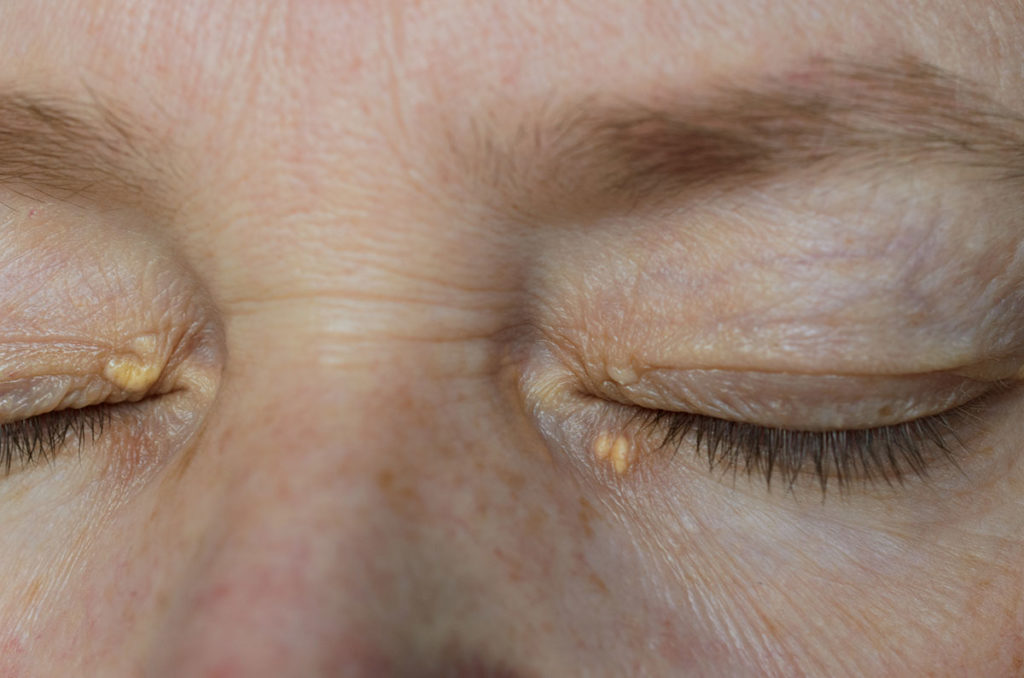 Xantelasma en los ojos de una mujer debido al colesterol alto