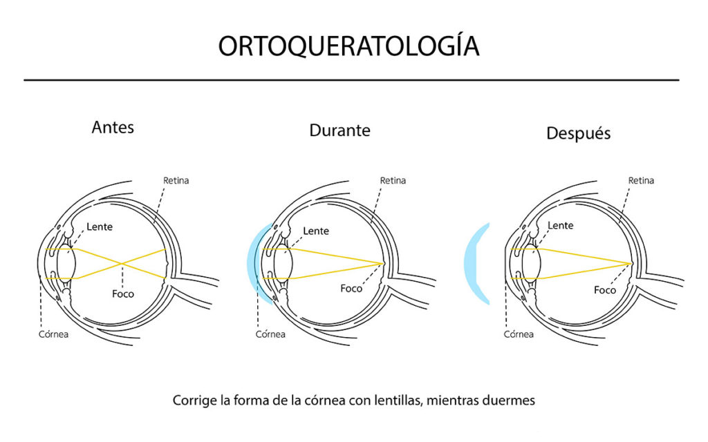 Qué son las lentes Orto K? Descubre la Ortoqueratología