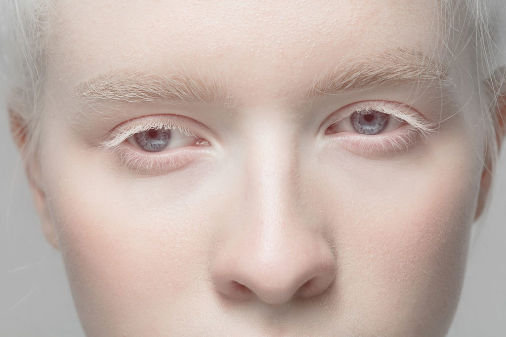 Albinismo: qué es y cómo afecta a la vista