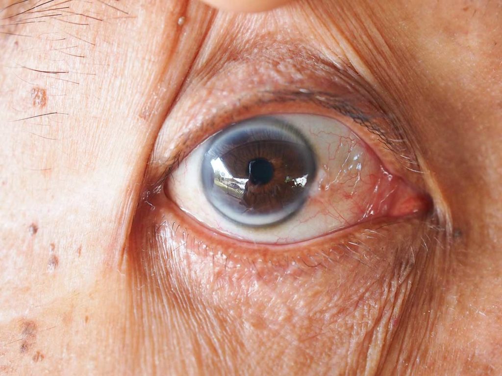 Arco senil, molestias oculares frecuentes a partir de los 60 años